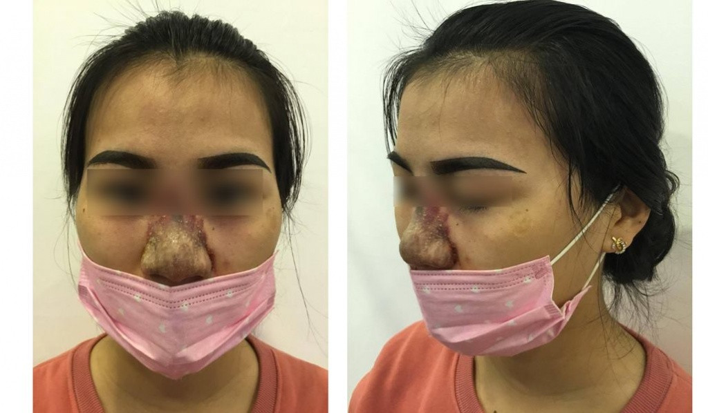 Nhan nhan quang cao nang mui gia sieu re tu 1,5 trieu dong-Hinh-4