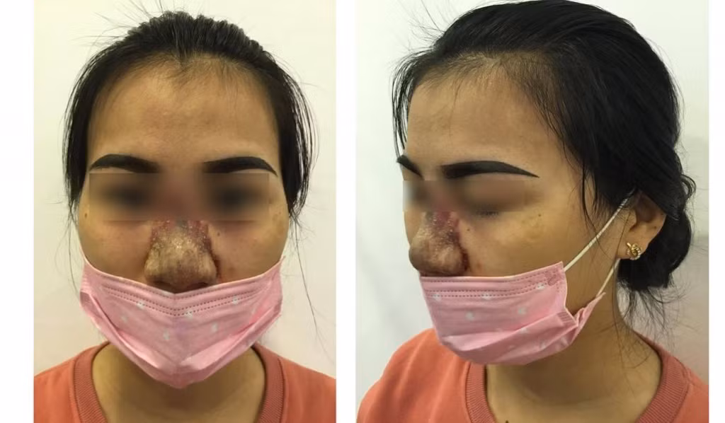 Nhan nhản quảng cáo nâng mũi giá siêu rẻ từ 1,5 triệu đồng - Hình 4 Nhan nhan quang cao nang mui gia sieu re tu 1,5 trieu dong-Hinh-4