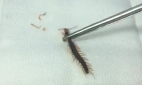 Con rết được các bác sĩ gắp ra.