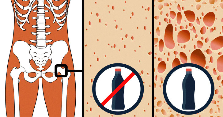 Soda chứa cả axit photphoric và caffeine làm giảm mật độ khoáng xương (BMD) và hậu quả là gây loãng xương.