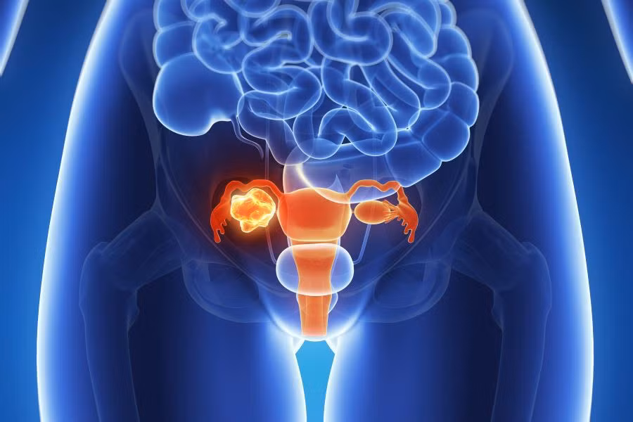 Ung thư buồng trứng: Đau bụng là một trong những triệu chứng cảnh báo sớm của ung thư buồng trứng, nhưng thường bị bỏ qua do khá giống các bệnh thông thường. Nếu phụ nữ thường xuyên bị đau bụng, kinh nguyệt không đều, chướng bụng hay cảm thấy no dù ăn rất ít, bạn nên đi siêu âm hoặc chụp CT xem có khối bất thường nào ở buồng trứng hay không. Ảnh: Namasterevista.