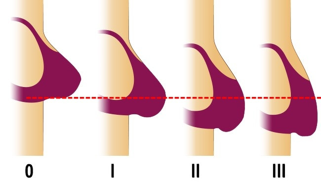 Các nhà khoa học phát hiện áo lót làm cho cơ ngực yếu đi. Các chuyên gia khẳng định rằng bạn nên mặc áo ngực vừa vặn để cảm thấy thoải mái.
