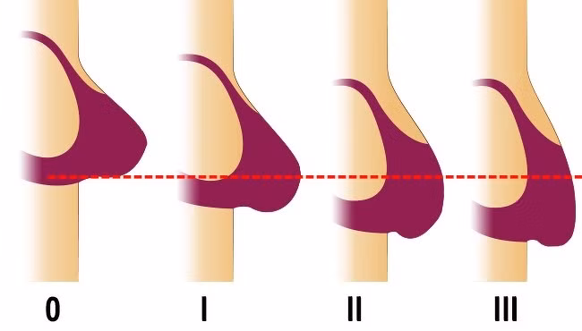 Các nhà khoa học phát hiện áo lót làm cho cơ ngực yếu đi. Các chuyên gia khẳng định rằng bạn nên mặc áo ngực vừa vặn để cảm thấy thoải mái.