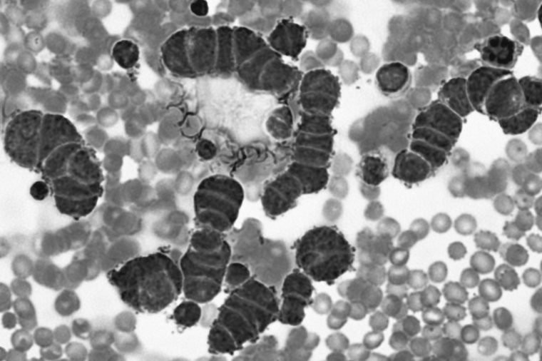 Các bệnh ung thư đường hô hấp: Ung thư khí quản, phế quản và phổi gây ra 1,7 triệu ca tử vong trong năm 2016, theo WHO và đứng thứ sáu trong danh sách những bệnh gây tử vong hàng đầu thế giới.