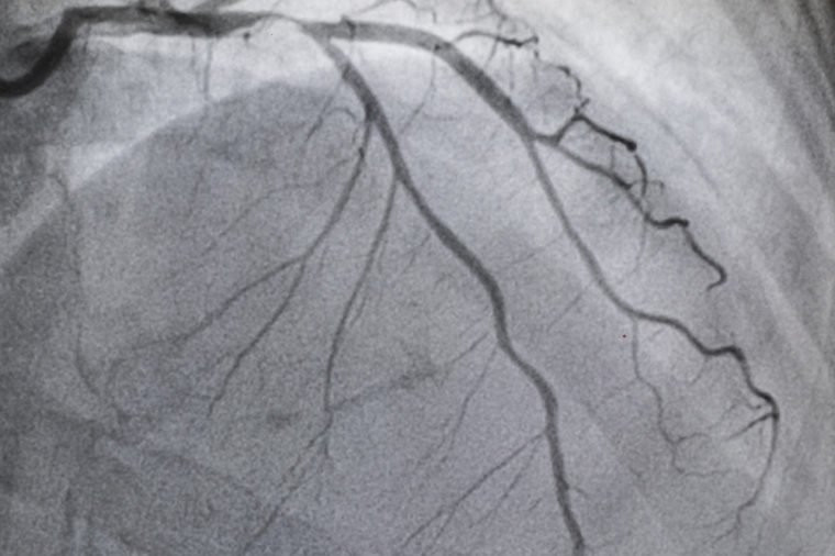 Bệnh tim mạch vành (thiếu máu cục bộ tim) là căn bệnh đáng sợ gây tử vong hàng đầu trên toàn thế giới, theo Tổ chức Y tế Thế giới (WHO). Bệnh tim mạch và đột quỵ chiếm tổng cộng 15,2 triệu ca tử vong trong năm 2016.