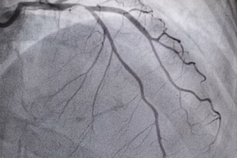 Bệnh tim mạch vành (thiếu máu cục bộ tim) là căn bệnh đáng sợ gây tử vong hàng đầu trên toàn thế giới, theo Tổ chức Y tế Thế giới (WHO). Bệnh tim mạch và đột quỵ chiếm tổng cộng 15,2 triệu ca tử vong trong năm 2016.