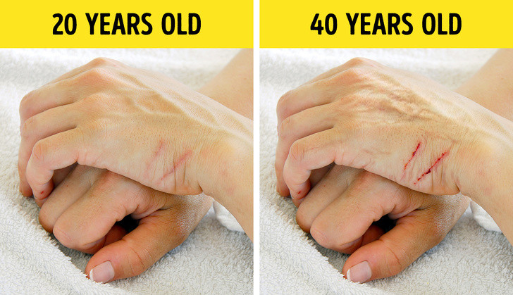 Chấn thương và vết bầm tím lâu lành hơn chính là một trong những dấu hiệu lão hóa sớm. Da người có khả năng tái tạo tuyệt vời nhưng khi bạn có tuổi, khả năng này sẽ suy giảm đáng kể. 