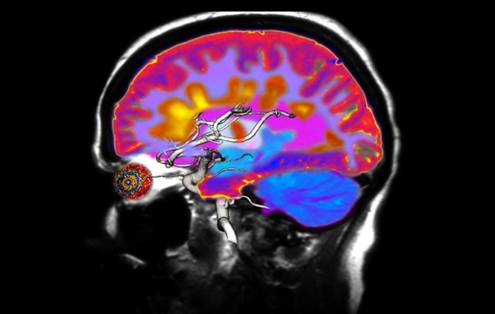 Đa xơ cứng: Bệnh đa xơ cứng là một căn bệnh trong đó hệ miễn dịch của bạn tấn công một chất béo bảo vệ các sợi thần kinh của não và tủy sống. Điều đó có thể dẫn đến tê tay.