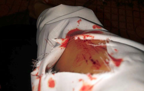 Bi 2 ke di xe may tan cong, co gai phai tiem thuoc phoi nhiem HIV-Hinh-3