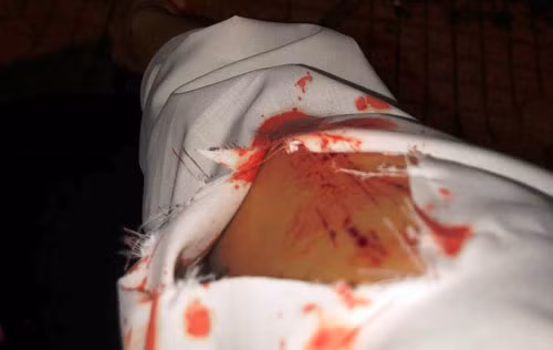 Bi 2 ke di xe may tan cong, co gai phai tiem thuoc phoi nhiem HIV-Hinh-3