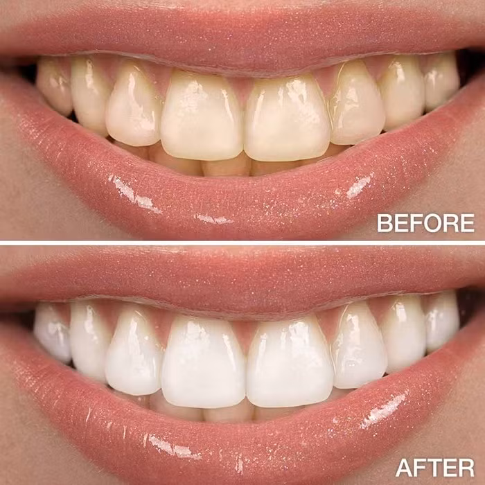 Cach lam trang rang tuc thi voi hon hop tu che tu tu nhien-Hinh-4