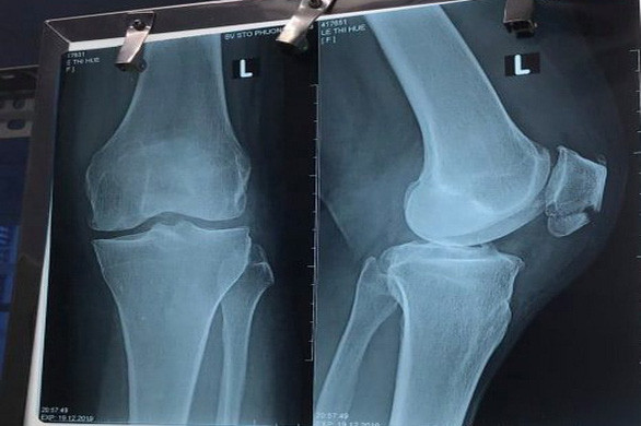 Gay xuong chan, benh nhan tu vong tai BV STO Phuong Dong