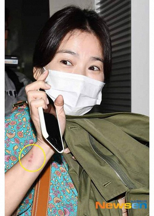 Nhiều người tò mò những vết thương trên tay của nữ diễn viên.