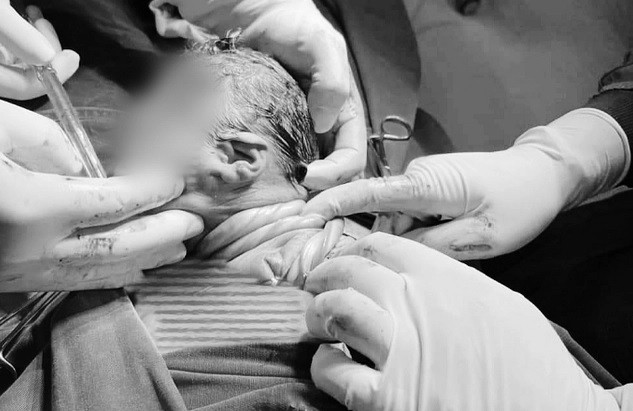 Phau thuat cuu thai nhi co day ron quan co 3 vong