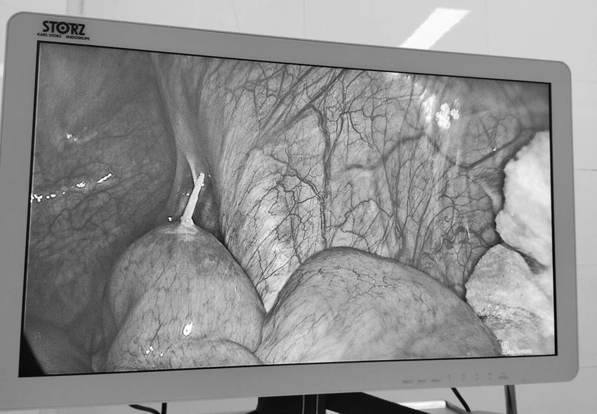 Bệnh nhân bị thủng ruột non do nuốt phải tăm tre Benh nhan bi thung ruot non do nuot phai tam tre