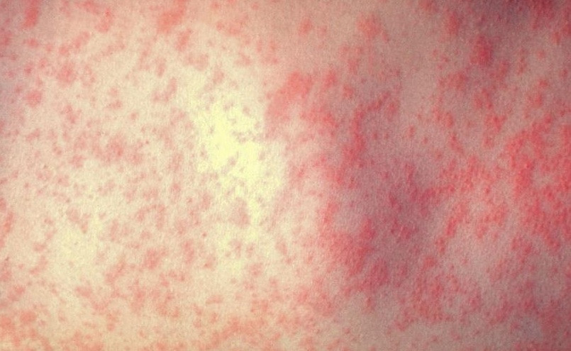 Nguyên nhân khiến dịch sởi bao trùm châu Âu Nguyen nhan khien dich soi bao trum chau Au