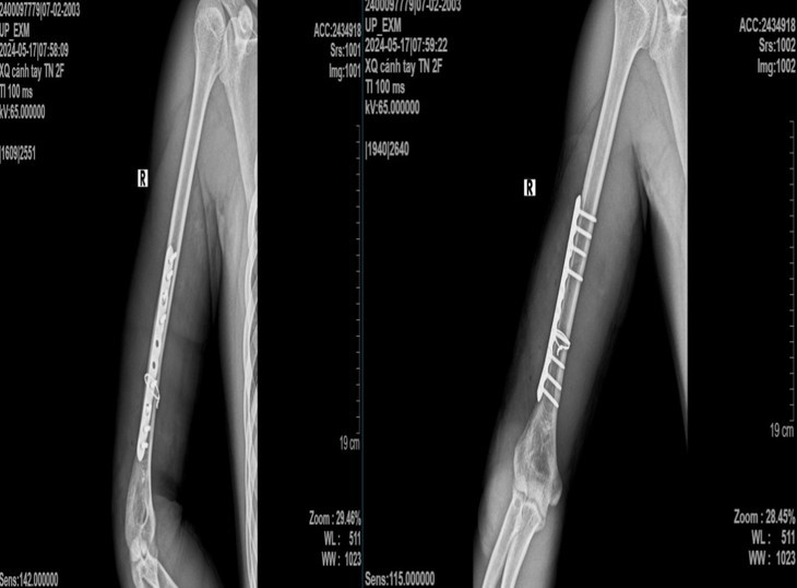 Nam thanh nien 21 tuoi gay xuong canh tay khi choi vat tay-Hinh-2
