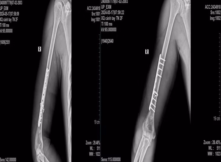 Nam thanh nien 21 tuoi gay xuong canh tay khi choi vat tay-Hinh-2