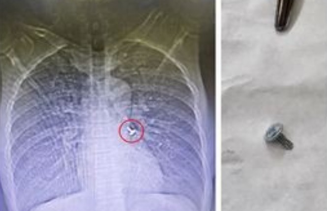 Dinh vit nhon lac trong phe quan nguoi dan ong 61 tuoi-Hinh-2