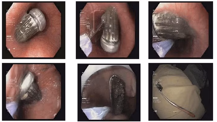 Nu sinh vo tinh nuot ban chai danh rang dai 15 cm vao bung