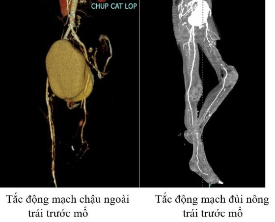 Hoai tu chi, dot tu vi tac dong mach mua ret