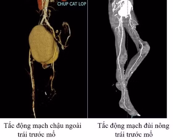 Hoai tu chi, dot tu vi tac dong mach mua ret