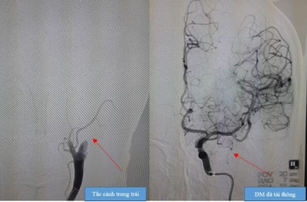 Chong mat… coi chung nguy co dot quy, cho chu quan-Hinh-2