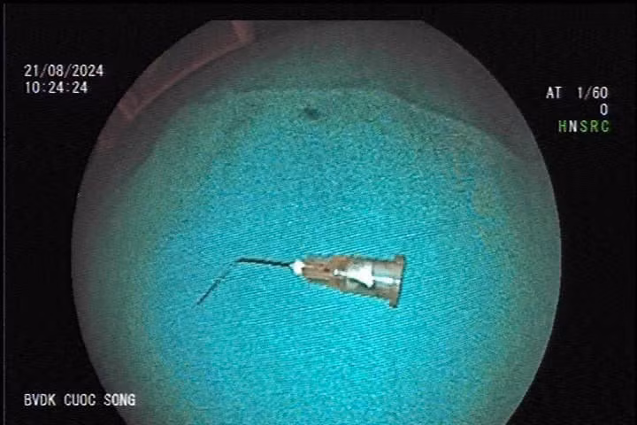 Be trai 10 tuoi nuot kim tiem vao da day khi di chua rang