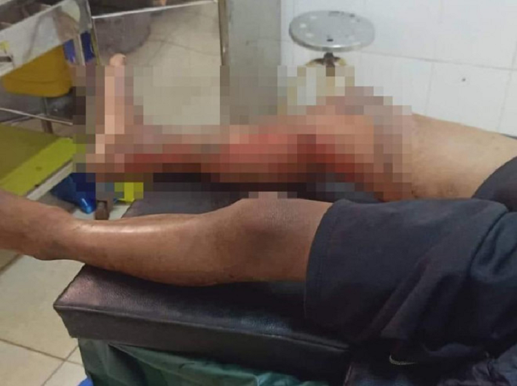 Gia canh khon kho cua be 8 tuoi o Dak Lak bi dot bong 2 chan