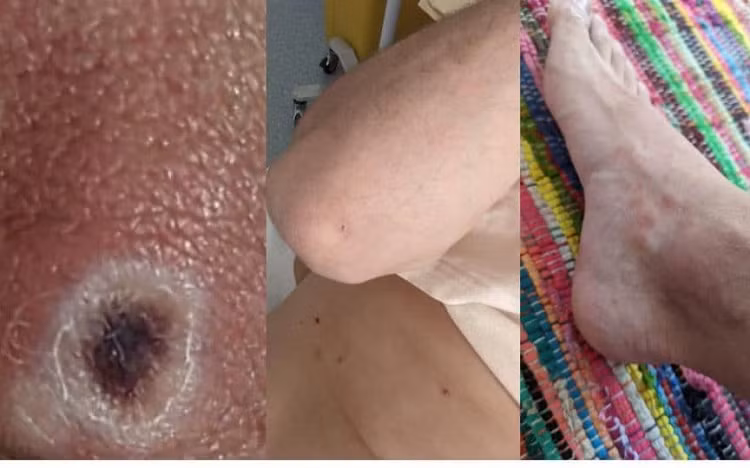 Ca dau tien mac dau mua khi: ‘Toi phat hien benh khi di kham vung kin’