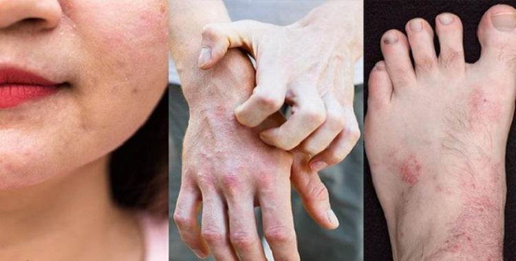 La lung benh mua dong bung phat giua mua he