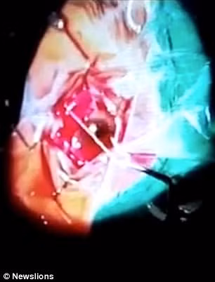 Kinh hoang giun dai 7 cm lam to trong mat