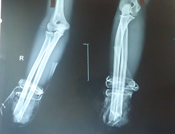 Benh vien DK Khanh Hoa noi thanh cong ban tay dut lia-Hinh-2