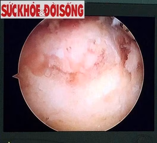 Lan dau tien noi soi khop co chan benh ly hiem gap-Hinh-2