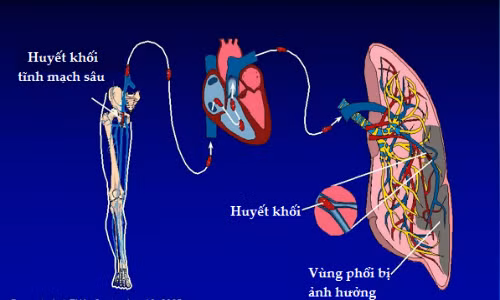Thuyen tac phoi suyt chet vi om may tinh hon 12 gio/ngay