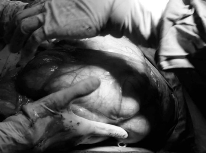 Nguoi phu nu mang khoi u hon 6kg trong bung nhung khong hay biet-Hinh-2