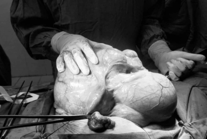 Nguoi phu nu mang khoi u hon 6kg trong bung nhung khong hay biet