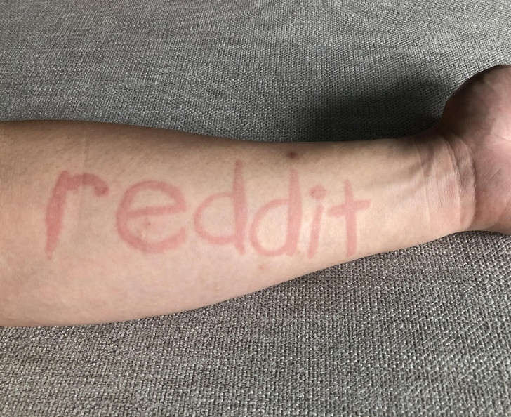 Mắc một chứng da liễu hiếm gặp, người đàn ông này có thể viết chữ lên cơ thể mình, những chữ cái sẽ nổi lên dưới dạng phát ban.