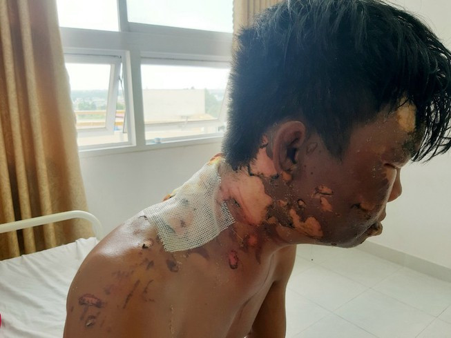 Thanh nien bi chi ruot do nuoc soi vao dau