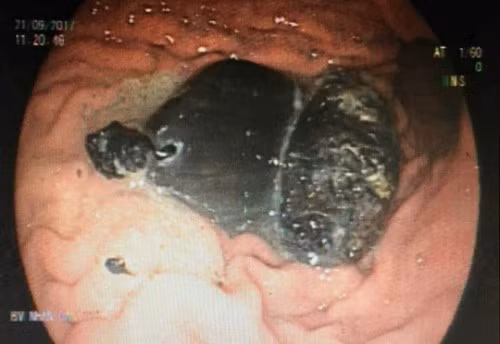 Co gai co hai tuong Phat bang kim loai nam gon trong da day