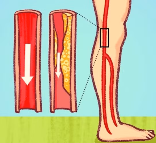 Bàn chân hoặc bàn tay lạnh: Bàn chân lạnh có thể là do bệnh động mạch ngoại biên (PAD) gây ra. Triệu chứng này xảy ra do các mạch máu bị co hẹp làm giảm lượng máu lưu thông đến các chi. Đặc biệt, bệnh động mạch ngoại biên cũng có thể là dấu hiệu cho thấy căn bệnh động mạch diện rộng trong cơ thể có thể ảnh hưởng đến não bộ hoặc tim mạch, gây ra cơn đau tim hoặc đột quỵ.