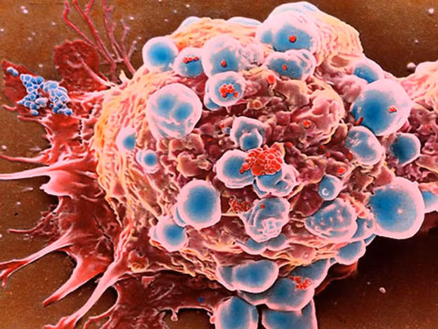 Các thành viên trong gia đình cùng bị ung thư không chỉ giới hạn ở cha mẹ con cái mà còn có cả vợ chồng và anh chị em. 4 yếu tố sau đây được xem là những nguyên nhân đang khiến xu hướng ung thư di truyền ngày càng gia tăng.