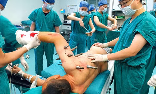 Song sot than ky sau khi bi 10 chiec dinh xuyen thung nguoi