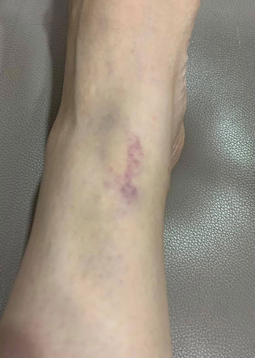 Chia sẻ hình ảnh chân bầm tím vì bị ngã khi đóng phim, Lý Nhã Kỳ hài hước chú thích: "Thiên đường là đây? Trong phim không có cảnh té, nhưng yêu nghề nên tặng ê-kíp, đạo diễn pha hành động té thiệt cho đẹp luôn".