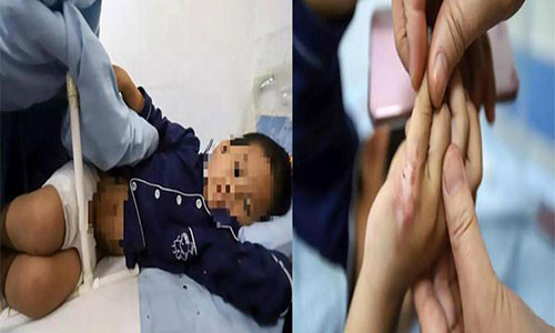 Cau be 7 tuoi bi me ke do nuoc soi len nguoi trung phat