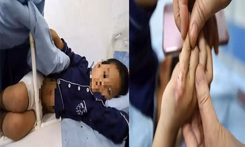 Cau be 7 tuoi bi me ke do nuoc soi len nguoi trung phat