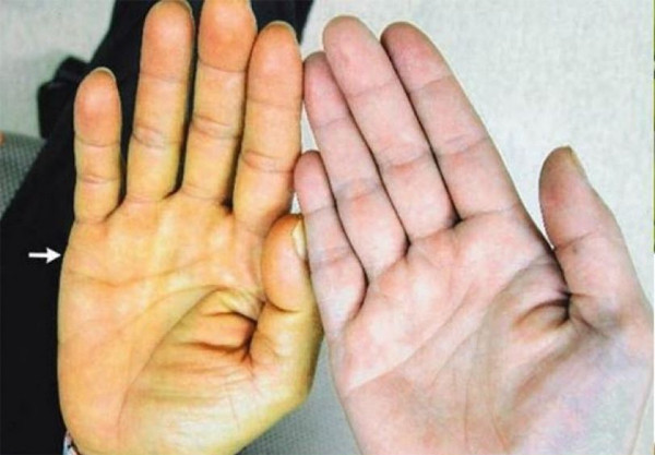 Ngoài ba vị trí “bốc mùi” trên, cơ thể sẽ phát ra một số dấu hiệu gan không khỏe. Bạn cần hết sức cảnh giác. Chẳng hạn, lòng trắng mắt chuyển vàng, lòng bàn tay đỏ ửng, chảy máu lợi, da xuất hiện ban đỏ giống như mạng nhện...