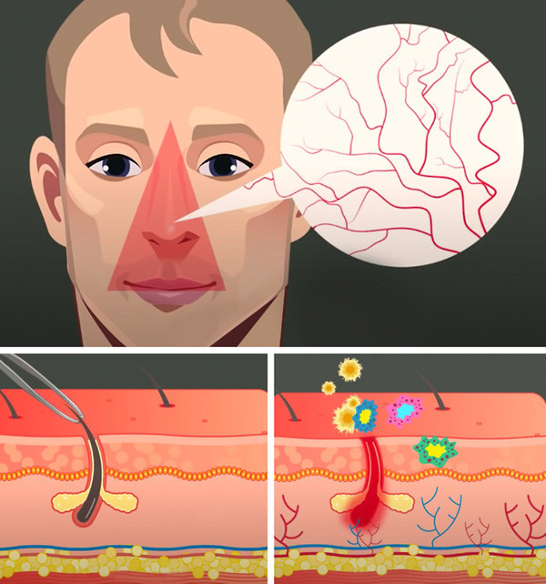 Nhổ lông mũi. Nhiều người khó chịu với chút lông mũi mọc ra ngoài, dùng nhíp nhổ đi. Vậy nhưng, việc làm này trái với sự phát triển tự nhiên. Thực vậy, lông mũi là một phần hệ thống bảo vệ cơ thể, giúp ngăn bụi, chất gây dị ứng, côn trùng thâm nhập vào phổi. Nhổ bỏ lông mũi dễ gây kích ứng, viêm nhiễm, khiến lông mọc ngược, đau ngứa.