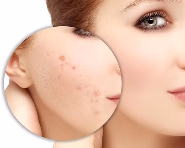 Thoa vitamin E lên mặt còn mang lại hiệu quả xóa sẹo ấn tượng. Làm được điều này là nhờ vitamin E có tác dụng chống oxy hóa, giúp phục hồi tế bào da ổn thương, thúc đẩy tái tạo tế bào mới, đẩy nhanh quá trình bong tróc và thoái hóa của da cũ. Kiên trì dùng vitamin E thoa lên mặt, vết sẹo sẽ được làm mềm, tạo các tế bào mới thay thế tế bào bị hỏng, mang lại hiệu quả xóa sẹo.