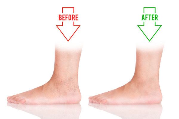 Người suy tĩnh mạch. Suy tĩnh mạch thường xảy ra với người phải đứng thời gian dài. Các chi dưới không được cung cấp máu kịp thời, chức năng van suy giảm khiến tình trạng suy giãn mạch máu ngày càng trầm trọng theo thời gian.